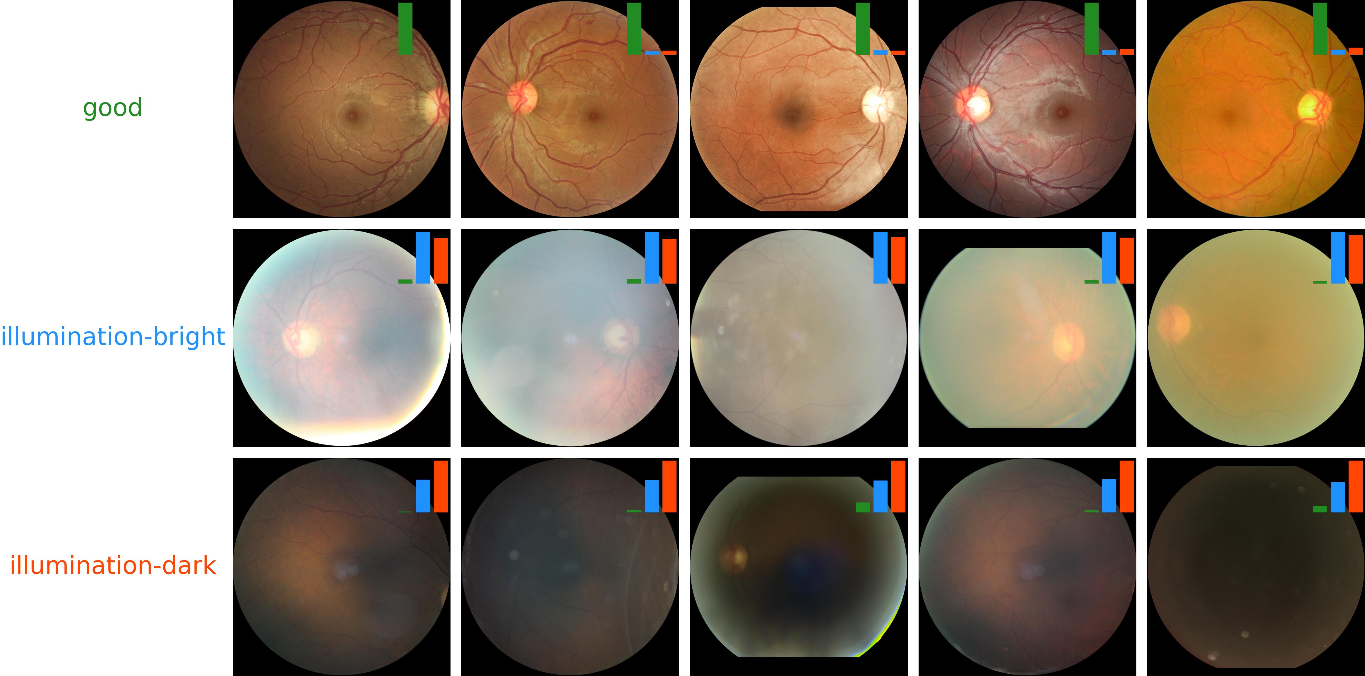 VISTA: Vision Improvement via Split and Reconstruct Deep Neural Network for Fundus Image Quality Assessment