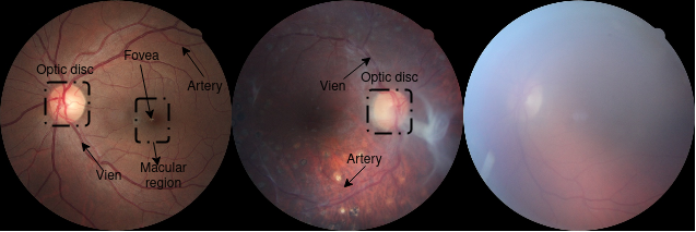 torch-eyepacs